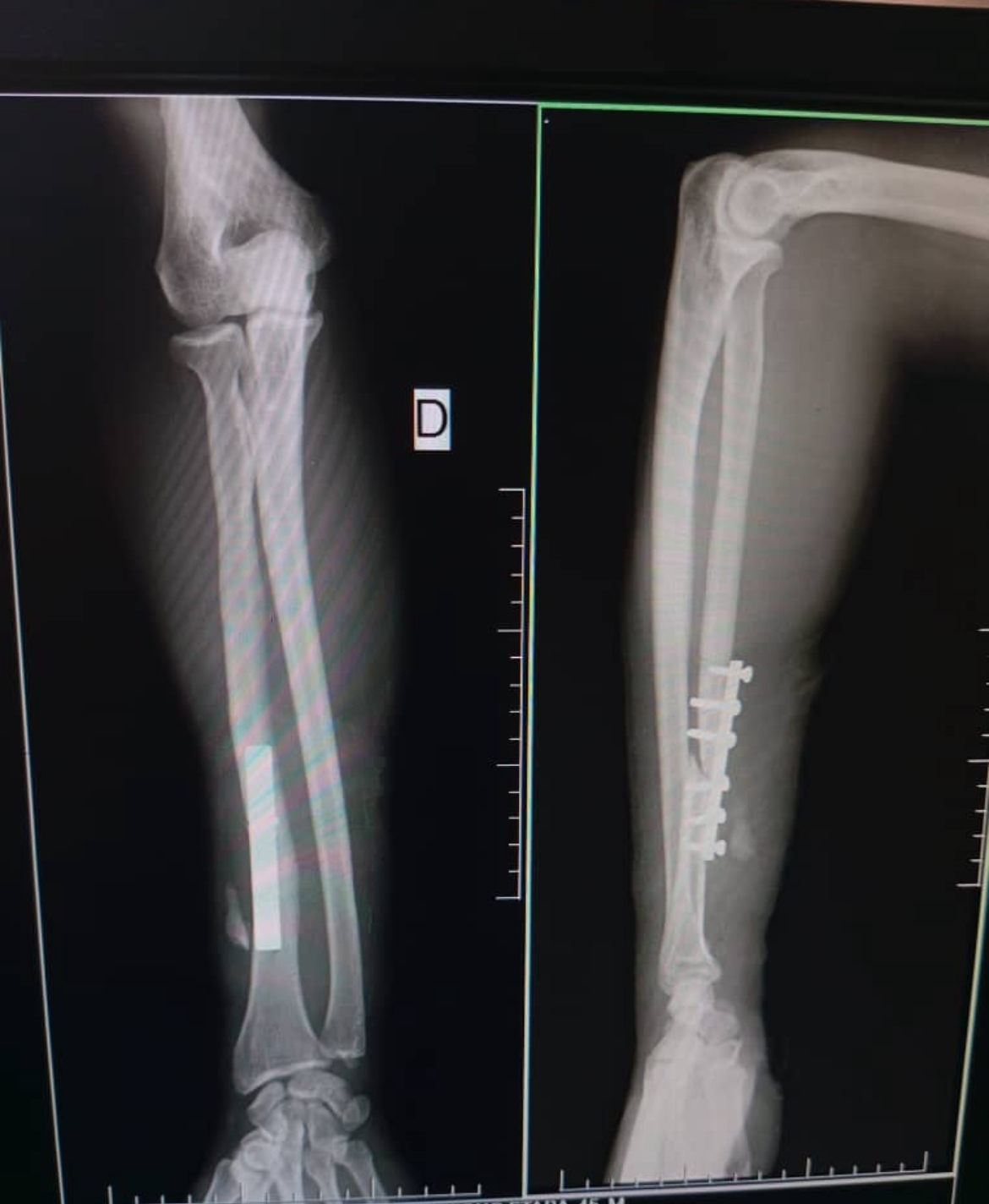 Radio après l'opération
